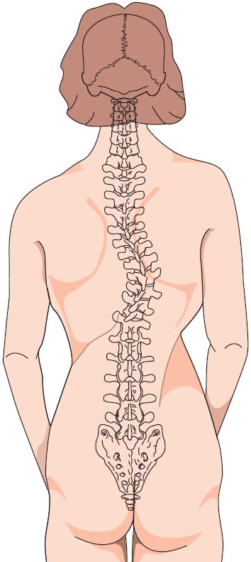 Scoliosis treatment to correct deviations of the spine