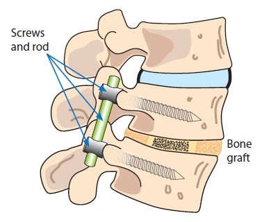 Sleeping With Scoliosis and Spinal Fusion